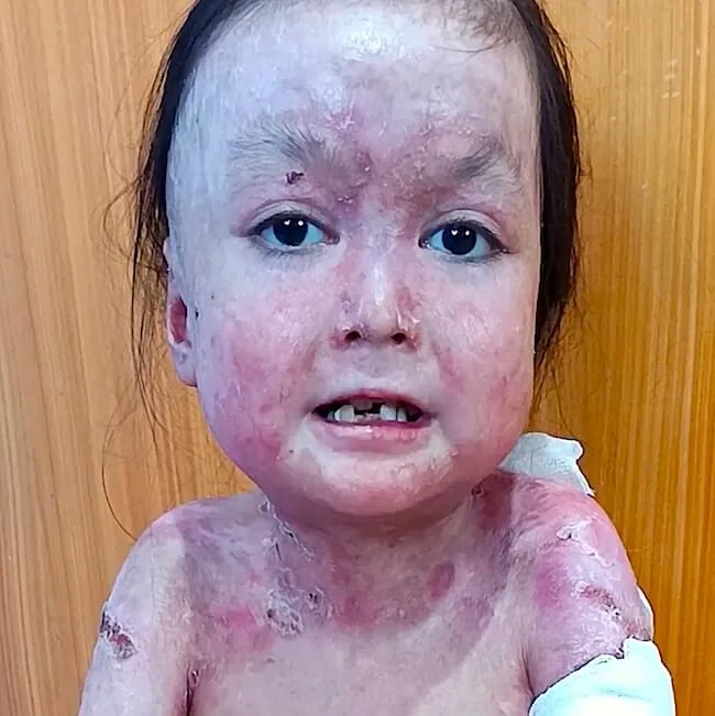 Shamila looking at the camera, with blisters and healing wounds on her face and shoulders